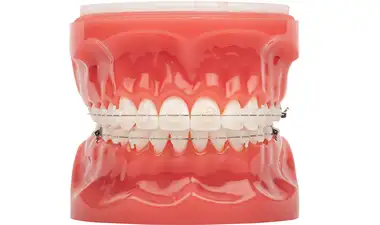 Ceramic braces Image
