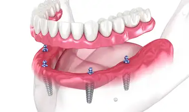 Implant Retained Dentures Image